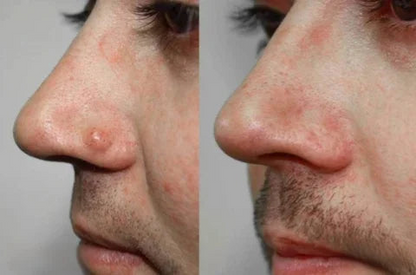 🔥ODALIT™ Natural Skin Tag and Wart Removal Patches