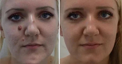 🔥ODALIT™ Natural Skin Tag and Wart Removal Patches