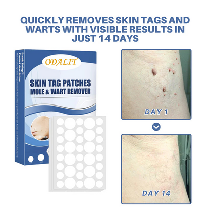 🔥ODALIT™ Natural Skin Tag and Wart Removal Patches
