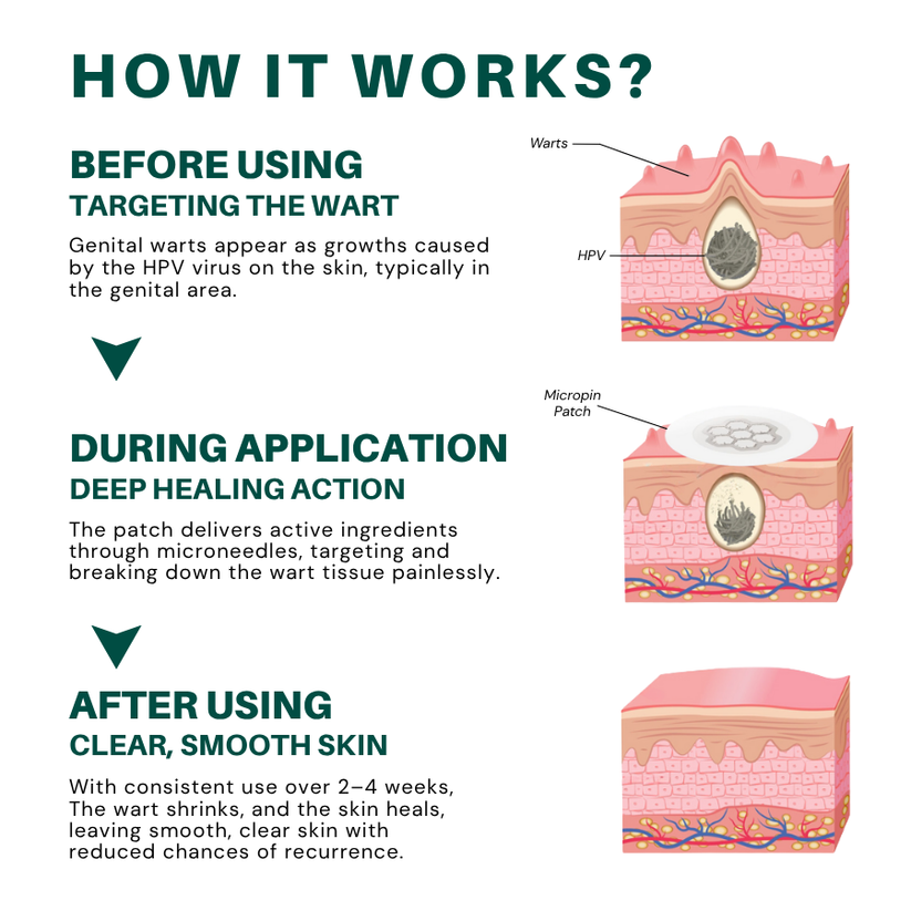 ODALIT™ Genital Wart Removal Patch – Now 40% OFF | Pain-Free, Clinically Proven Solution