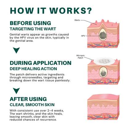 ODALIT™ Genital Wart Removal Patch – Now 40% OFF | Pain-Free, Clinically Proven Solution