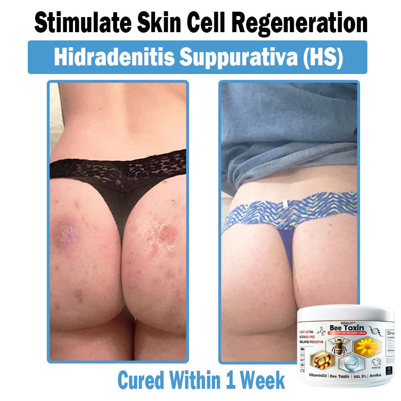 ODALIT™✨ Bee Toxin Multi-Symptom Skin Treatment Cream (👨‍⚕NPF RECOMMENDS)