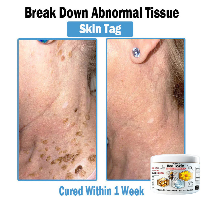 ODALIT™✨ Bee Toxin Multi-Symptom Skin Treatment Cream (👨‍⚕NPF RECOMMENDS)