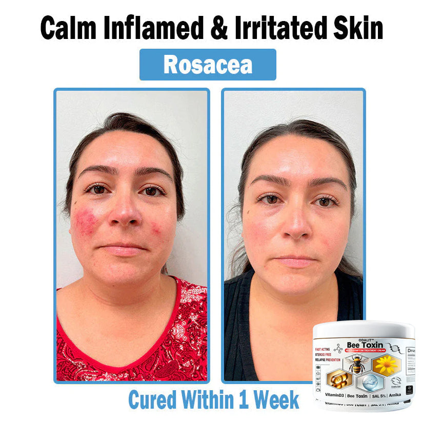 ODALIT™✨ Bee Toxin Multi-Symptom Skin Treatment Cream (👨‍⚕NPF RECOMMENDS)