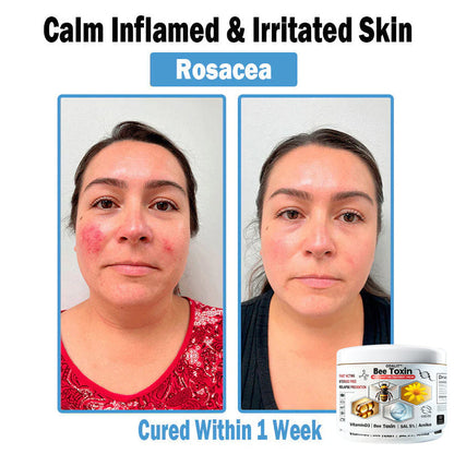 ODALIT™✨ Bee Toxin Multi-Symptom Skin Treatment Cream (👨‍⚕NPF RECOMMENDS)