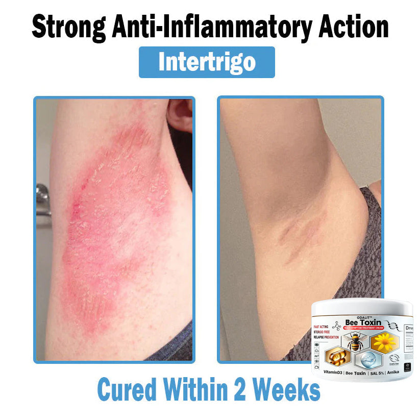 ODALIT™✨ Bee Toxin Multi-Symptom Skin Treatment Cream (👨‍⚕NPF RECOMMENDS)